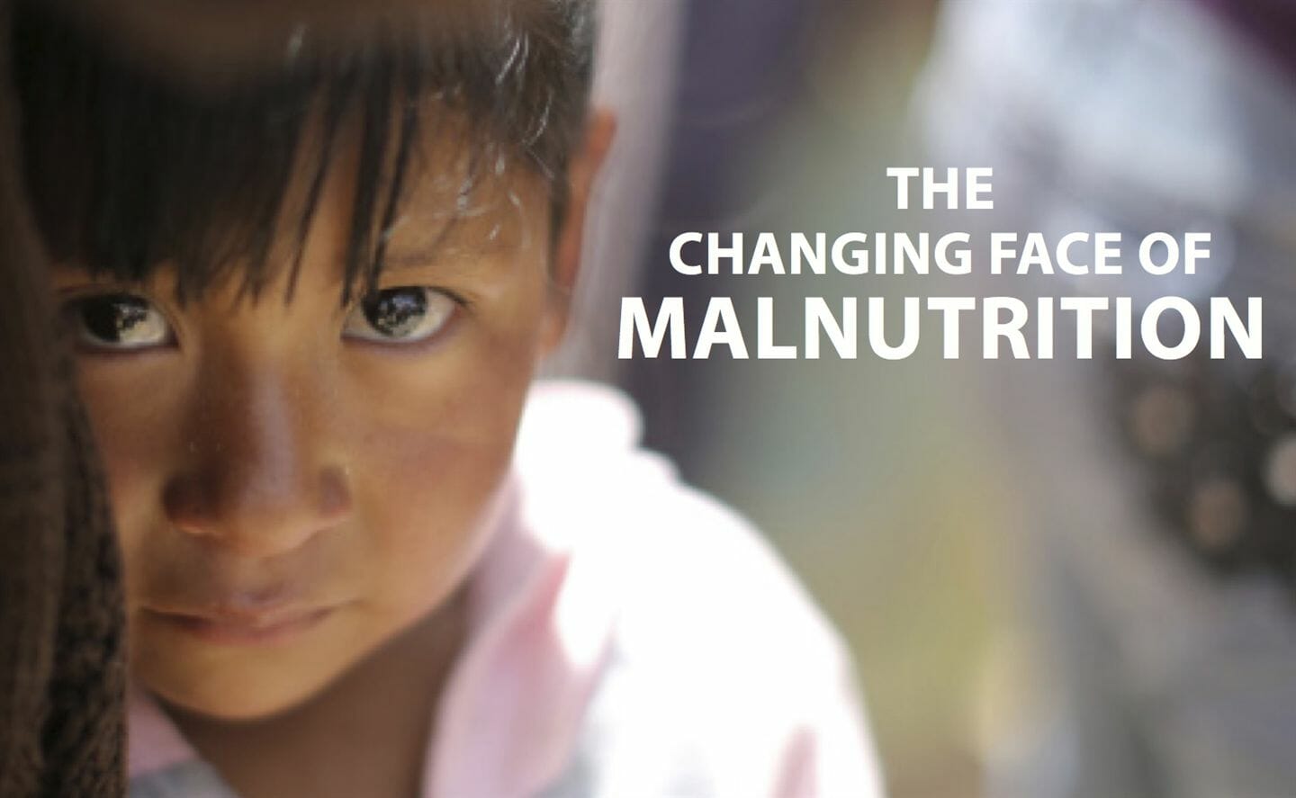 The changing face of malnutrition